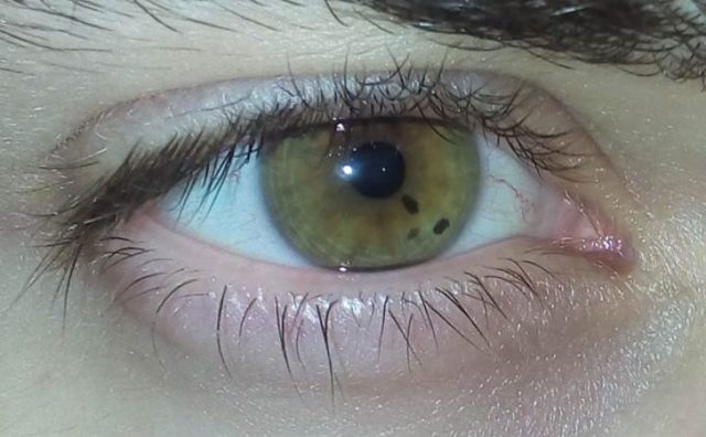 Черная точка в глазу на роговице передвигается с взглядом что это за болезнь