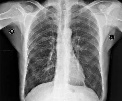 Симптомы и признаки бронхита на рентгене