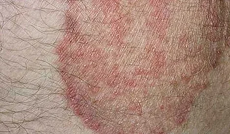 Шелушится кожа на лице: почему и что делать, советы дерматолога | РБК Стиль