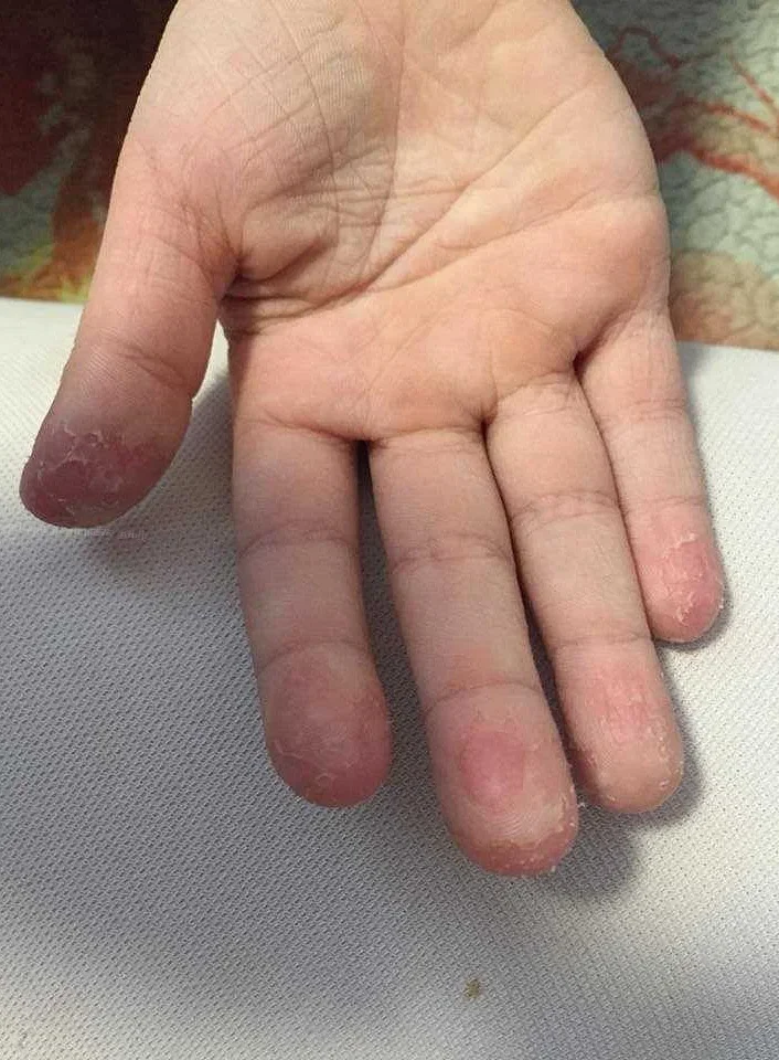 Почему облазит кожа на руках у ребенка: причины и как справиться
